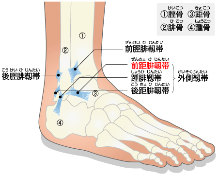 sprain_of_ankle.html.gif